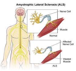 Pathology of amyotrophic lateral sclerosis