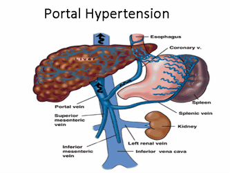 pathology of portal hypertension 