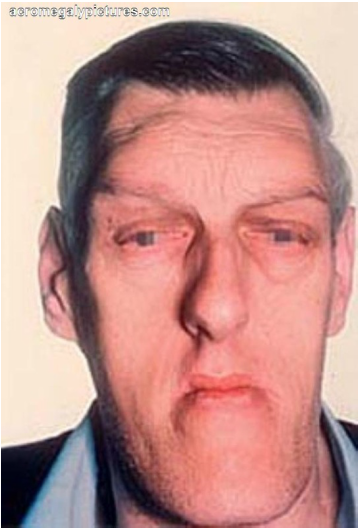 acromegaly symptoms 