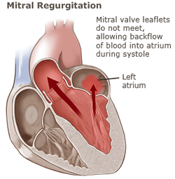 pathology of mitral regurgitation