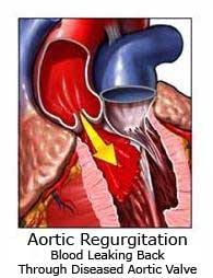 pathology of aortic regurgitation