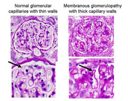 pathology of membranous glomerulonephritis