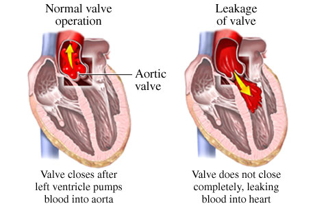 medical zone - aortic regurgitation 