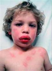 Pediatric Definition - Food Allergy 