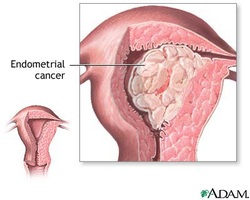 pathology of endometrial cancer