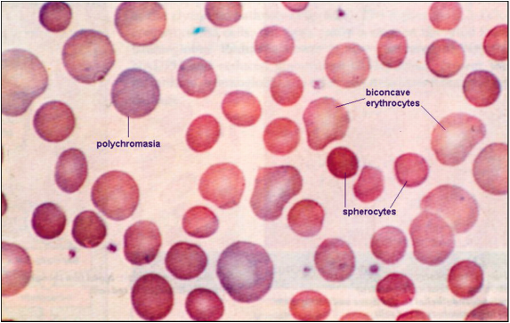 differential diagnosis of spherocytosis 