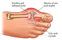 pathology of gout 