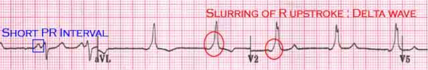 Differential Diagnosis of Short PR Interval