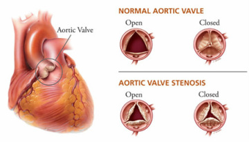 pathology of aortic stenosis 