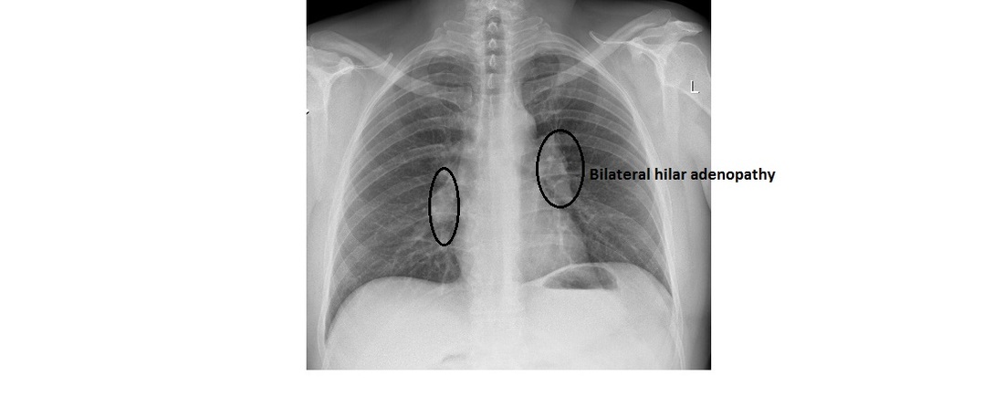 Differential Diagnosis Of Bilateral Hilar Lymphadenopathy Medical Zone
