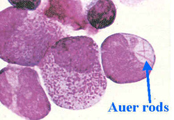 pathology of acute myelogenous leukemia 
