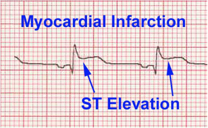 differential diagnosis of st elevation of myocardial infarction 