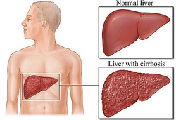 pathology of liver cirrhosis