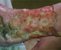 Diabetic Foot Ulcers: Prevention, Diagnosis and ...