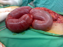 the causes of intestinal obstruction