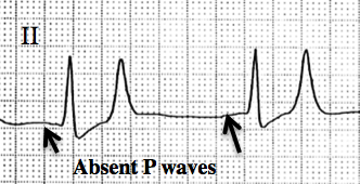 Differential Diagnosis of Absent P Wave on ECG 