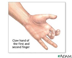 clinical examination of claw hand 