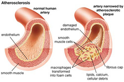 Pathology of atherosclerosis