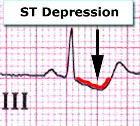 differential diagnosis of st segment depression on ecg