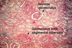 pathology of focal segmental glomerulosclerosis 