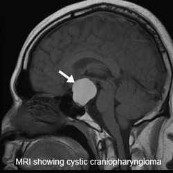 pathology of craniopharyngioma 