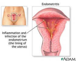 pathology of endometritis 