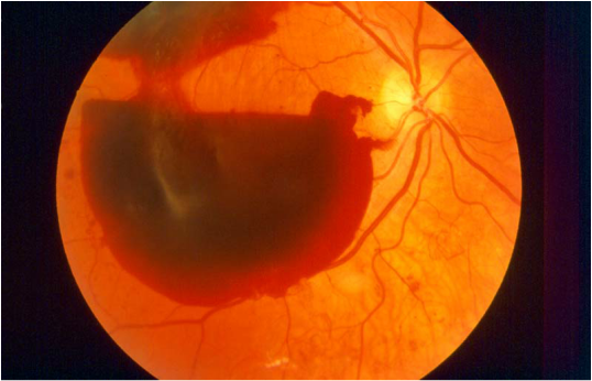 medical zone - retinal hemorrhage 