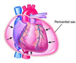 Pathology of cardiac tamponade