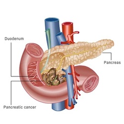 pathology of pancreatic carcinoma
