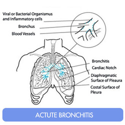 how to treat acute bronchitis