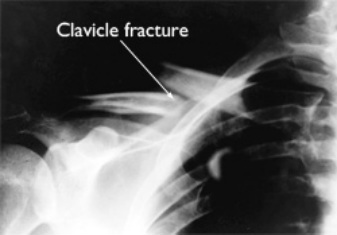 fracture of the clavicle