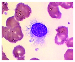 pathology of hairy cell leukemia 