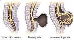 pathology of spina bifida