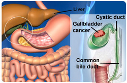 pathology of tumor of the gallbladder