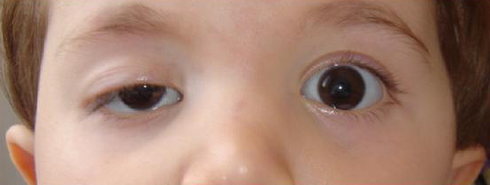 Pediatric Definition - Amblyopia 