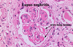 Pathology of lupus nephritis 