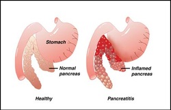 pathology of pancreatitis