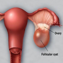 pathology of ovarian cyst
