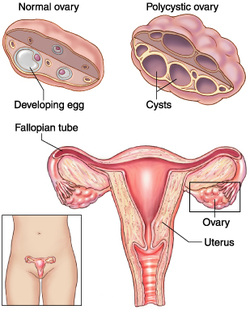 pathology of polycystic ovarian syndrome 