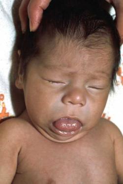 Pediatric definition - congenital hypothyroidism 