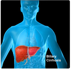 pathology of biliary cirrhosis