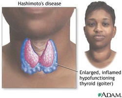pathology of hashimoto thyroiditis 