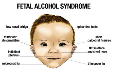 Pediatric Definition - Fetal Alcohol Syndrome 