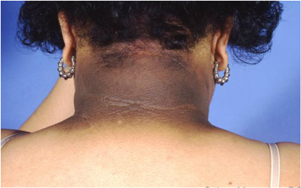 medical zone - acanthosis nigricans