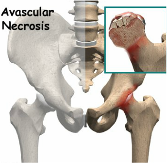 medical zone avascular necrosis 
