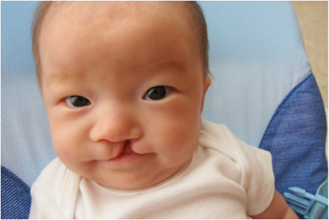 Pediatric Definition - Cleft Lip And Palate 