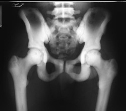 pathology of osteopetrosis 