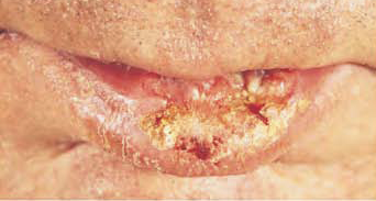 medical zone - lip erosion 