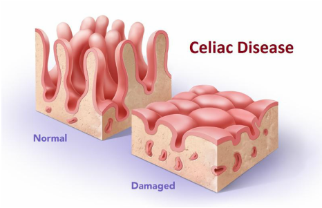 Pediatric Definition - Celiac Disease