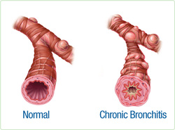 pathology of chronic bronchitis 